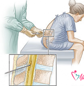 Anestesia epidurale. Ecco alcune risposte ai dubbi più frequenti